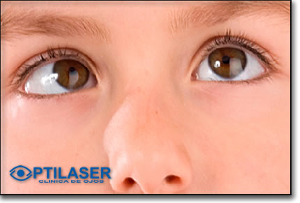Clinica de ojos Optilaser - Cirugia Estrabismo